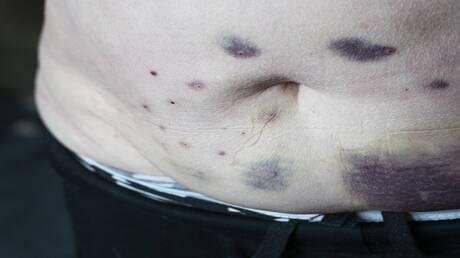 الكدمات المفاجئة قد تكون أحد أعراض مرض خطير