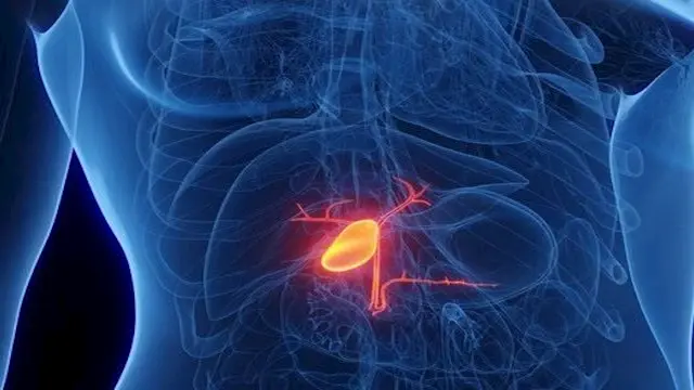 5 أعراض قد تكشف الإصابة بسرطان المرارة