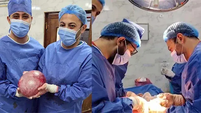 استخراج كيس ضخم من بطن سيدة في أسيوط