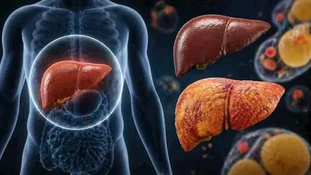 دراسة تحذر من خطر شائع على الكبد.. الباراسيتامول في الصدارة