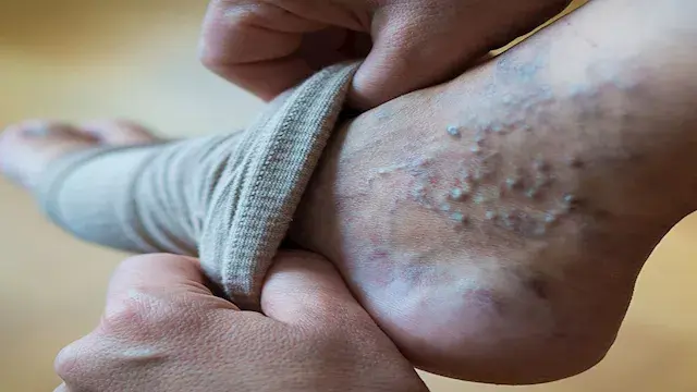ما أسباب زيادة خطر الإصابة بـ دوالي الساقين لدى النساء؟
