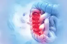 4 أعراض قد تكشف سرطان القولون مبكرا