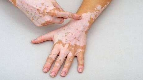 في إنجاز طبي هو الأول عالميا.. الإمارات تفتك بـ "لغز البهاق غير القطعي" Non-segmental vitiligo