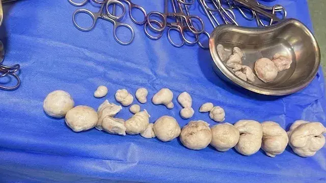 أنهت آلام عام ونصف.. استئصال 21 ورمًا ليفيًا من رحم سيدة بكفر الشيخ
