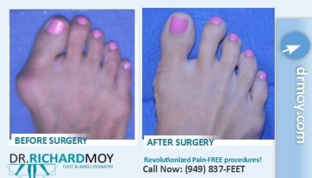 Dr. Richard Moy outshines competitors with innovative surgical methodology for painlessly removing bunions